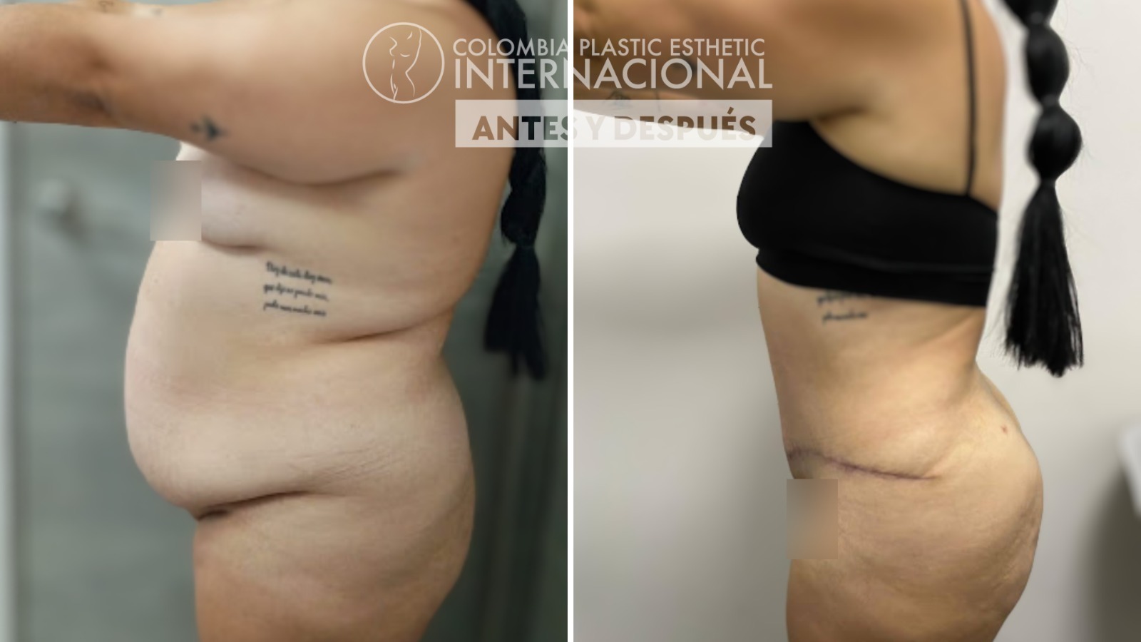 Transformación y Renacimiento: El Impactante Caso de Yadiris Tamayo con Lipoabdominoplastia y Transferencia Glútea