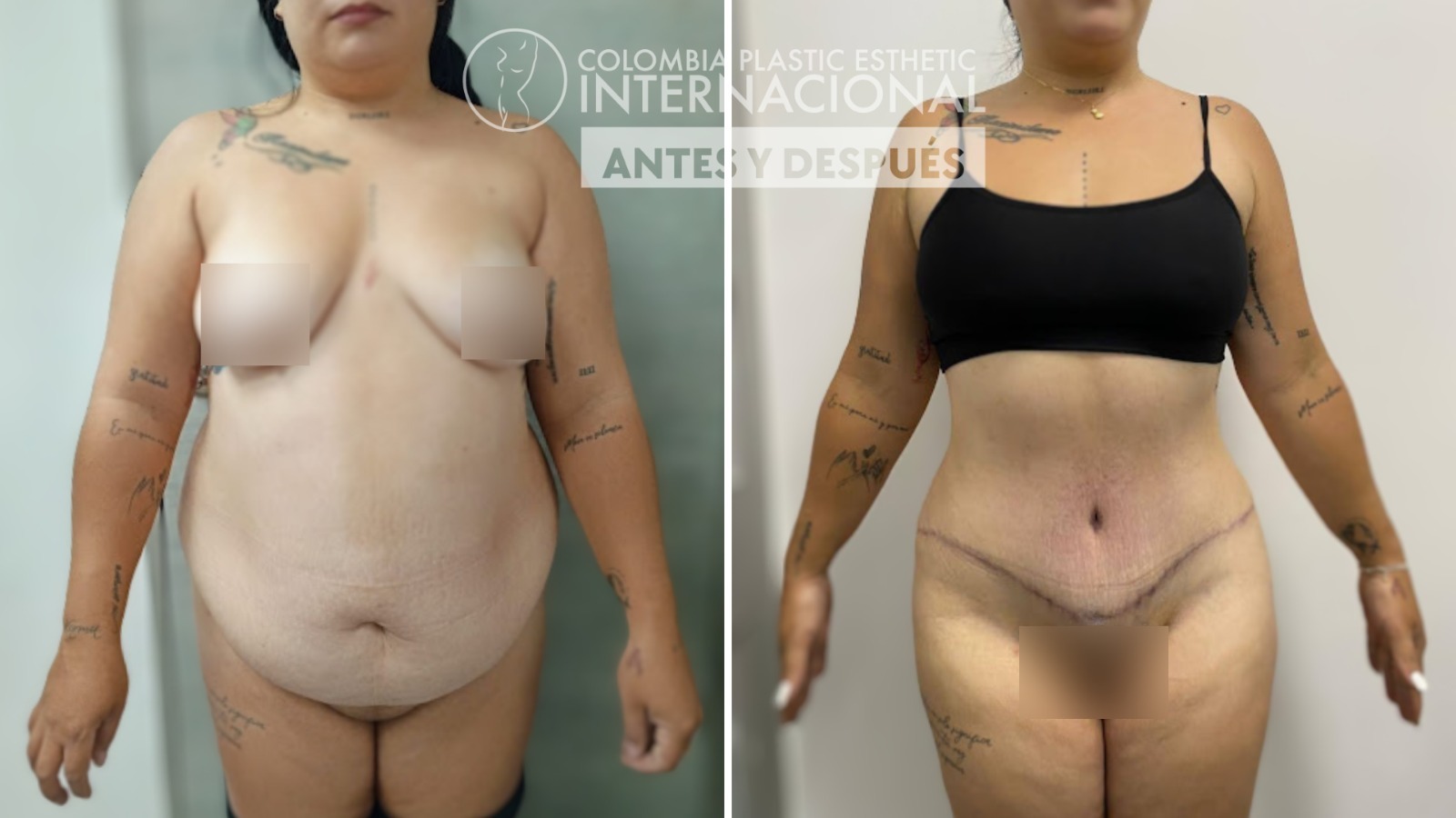 Transformación y Renacimiento: El Impactante Caso de Yadiris Tamayo con Lipoabdominoplastia y Transferencia Glútea