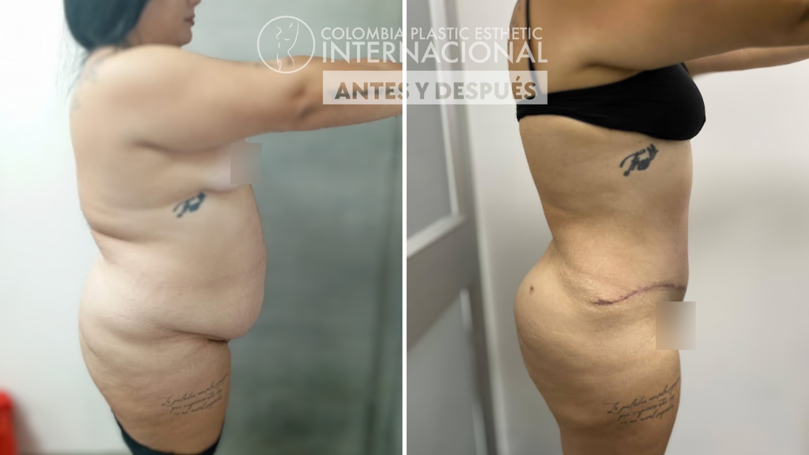 Transformación y Renacimiento: El Impactante Caso de Yadiris Tamayo con Lipoabdominoplastia y Transferencia Glútea