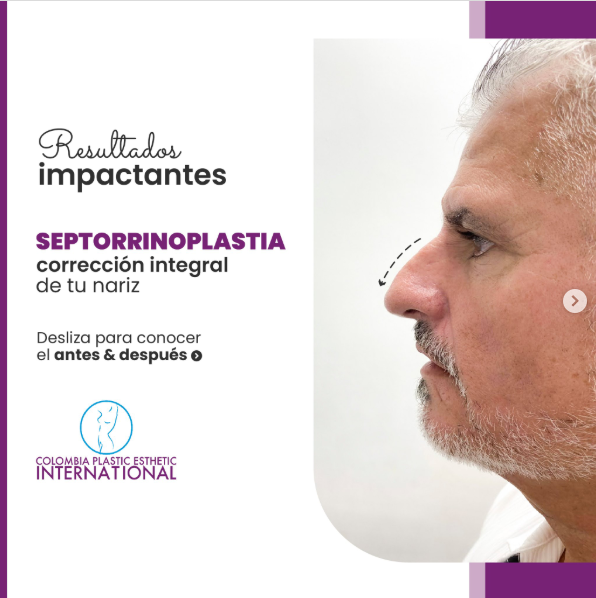 ¿Por qué pacientes de Puerto Rico confían en Colombia Plastic para su septorinoplastia en Medellín?