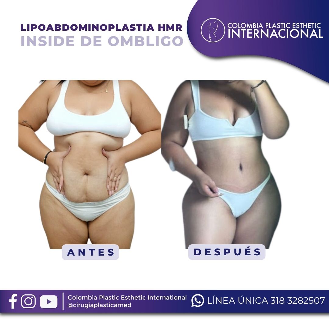 Lipoabdominoplastia HMR