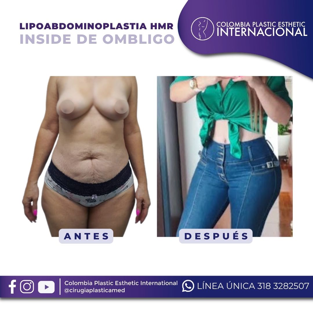 Lipoabdominoplastia HMR