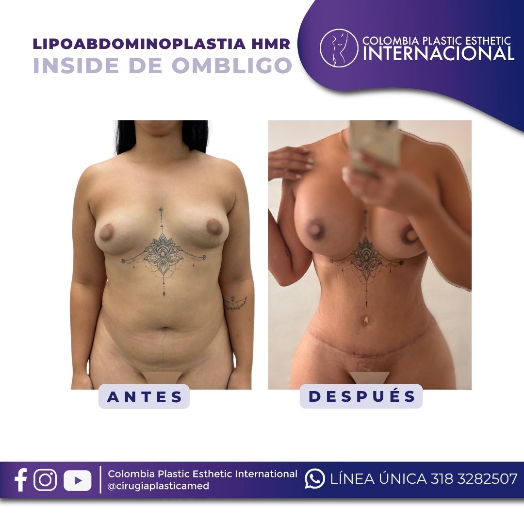 Lipoabdominoplastia HMR