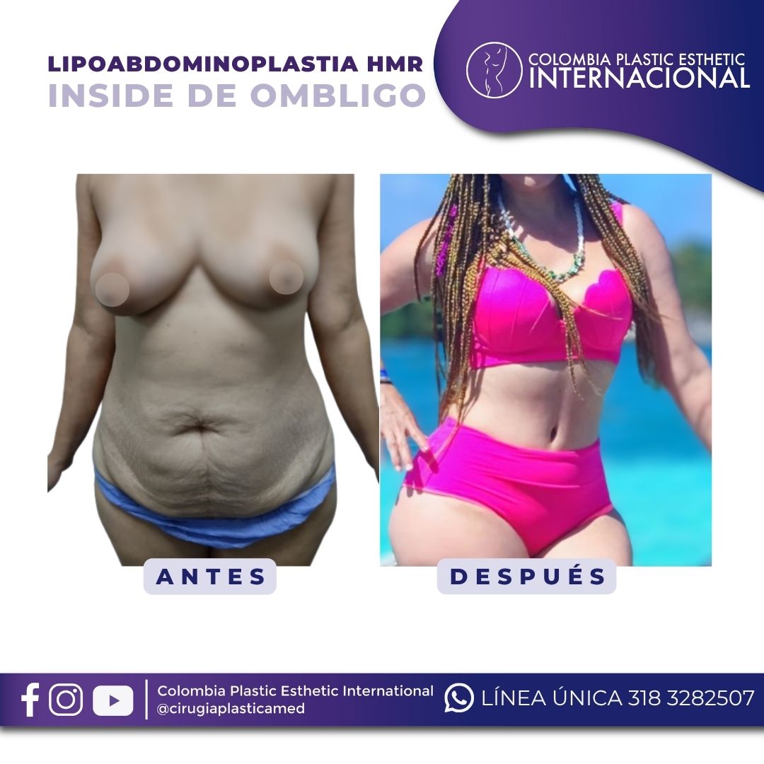 Lipoabdominoplastia HMR