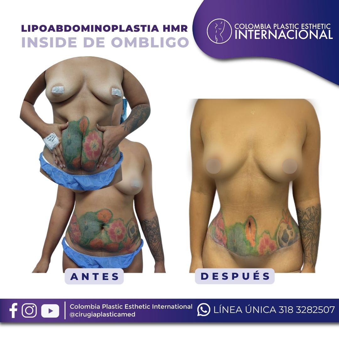 Lipoabdominoplastia HMR