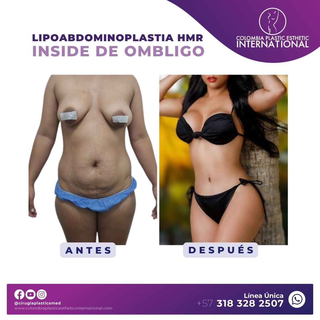 Lipoabdominoplastia HMR
