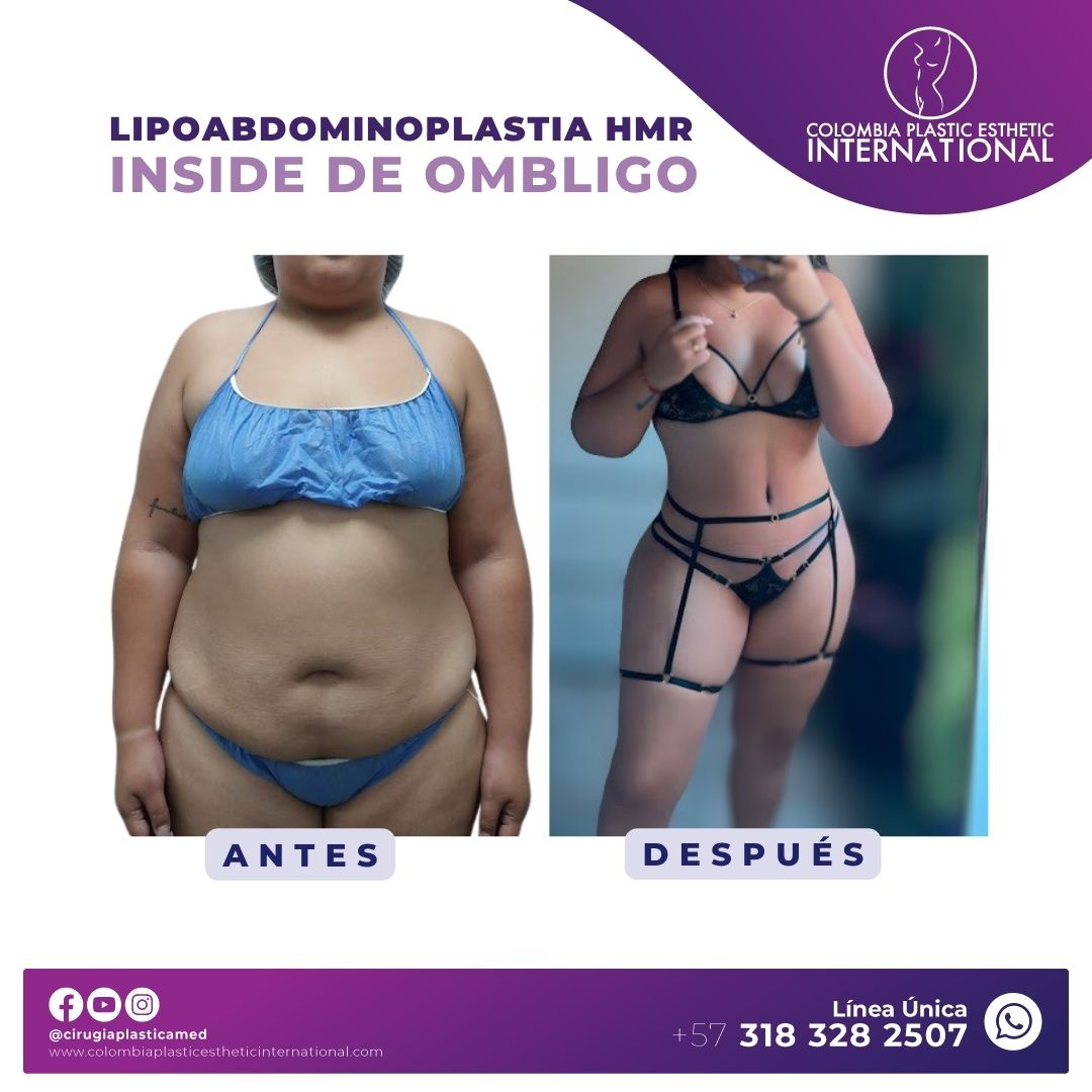 Lipoabdominoplastia HMR