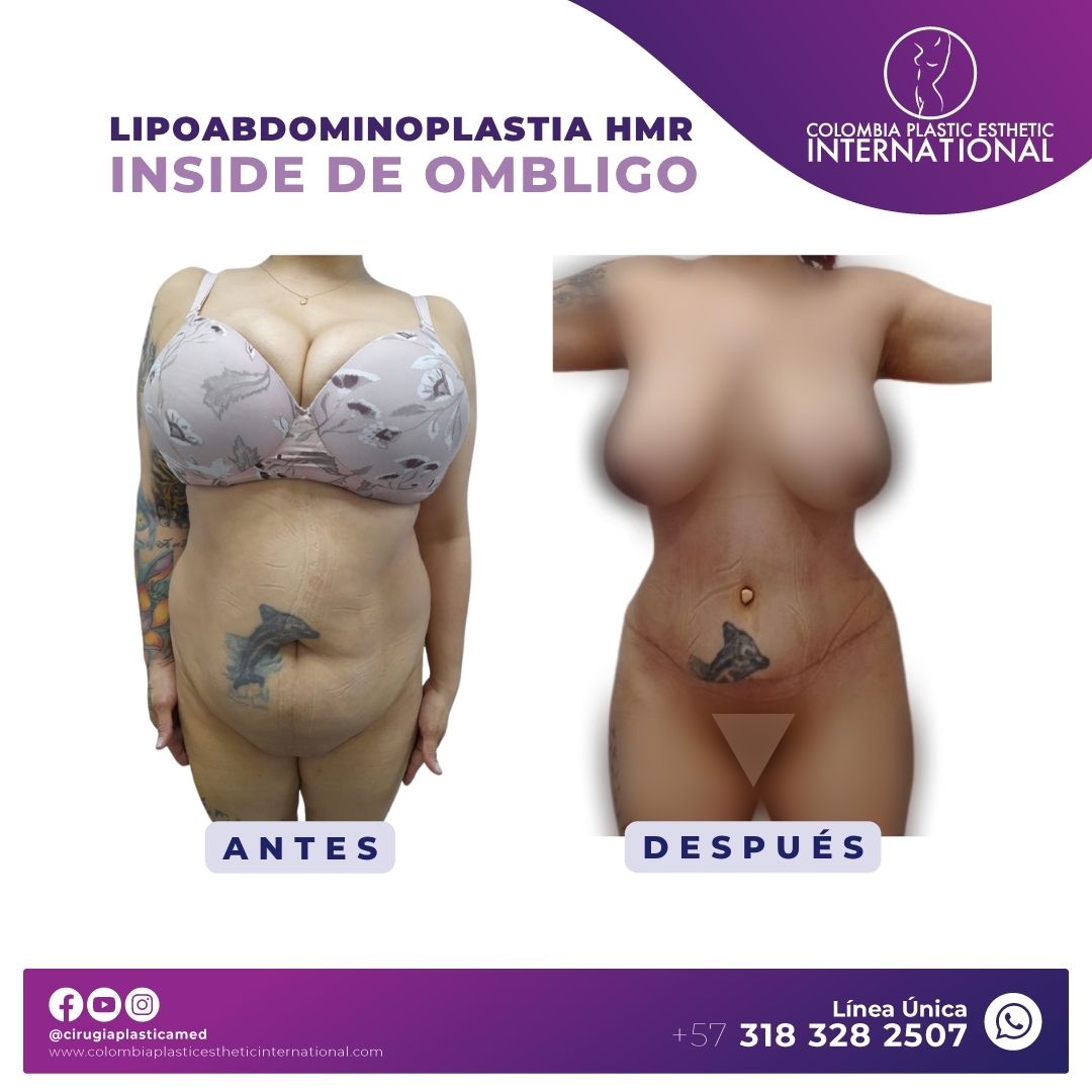 Lipoabdominoplastia HMR
