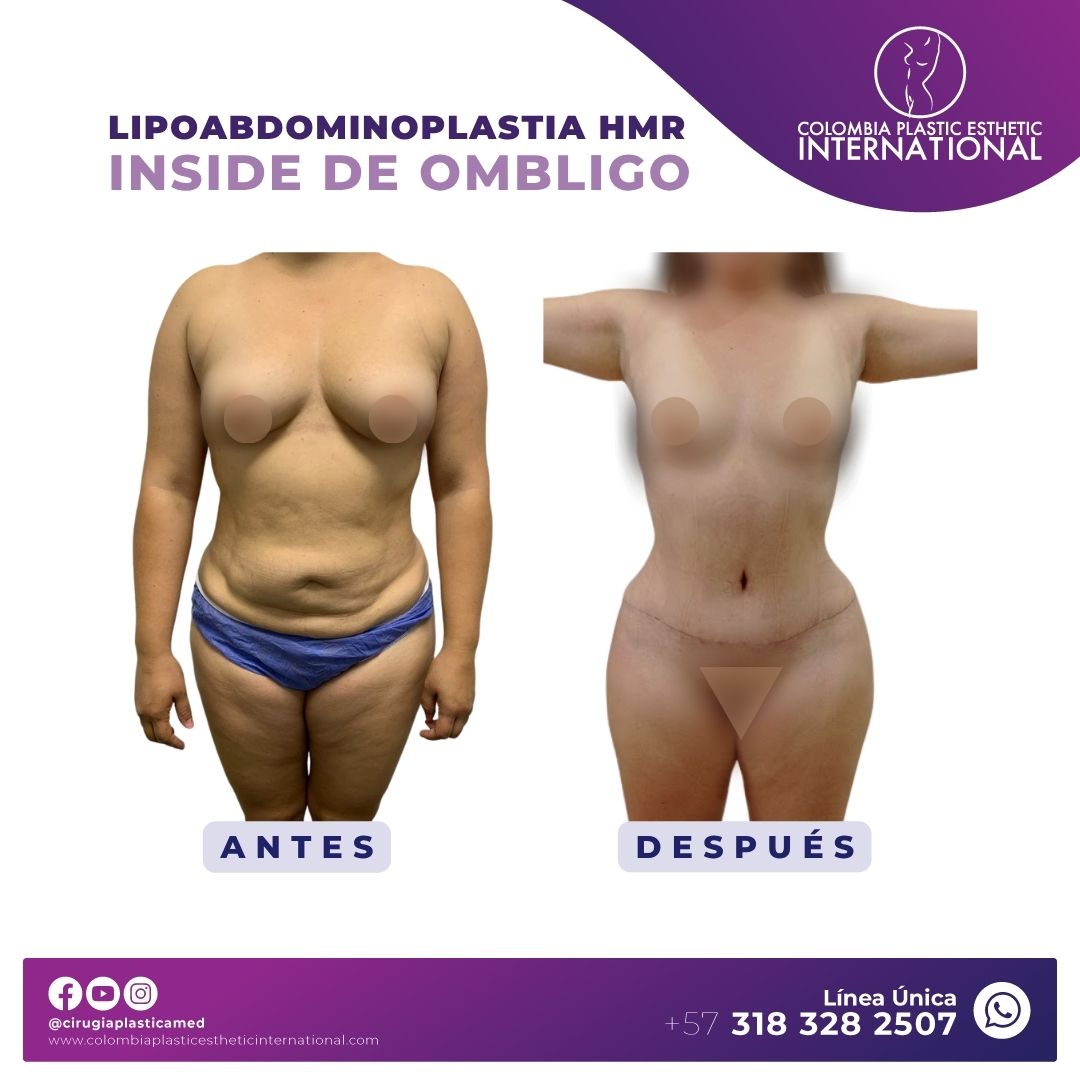 Lipoabdominoplastia HMR