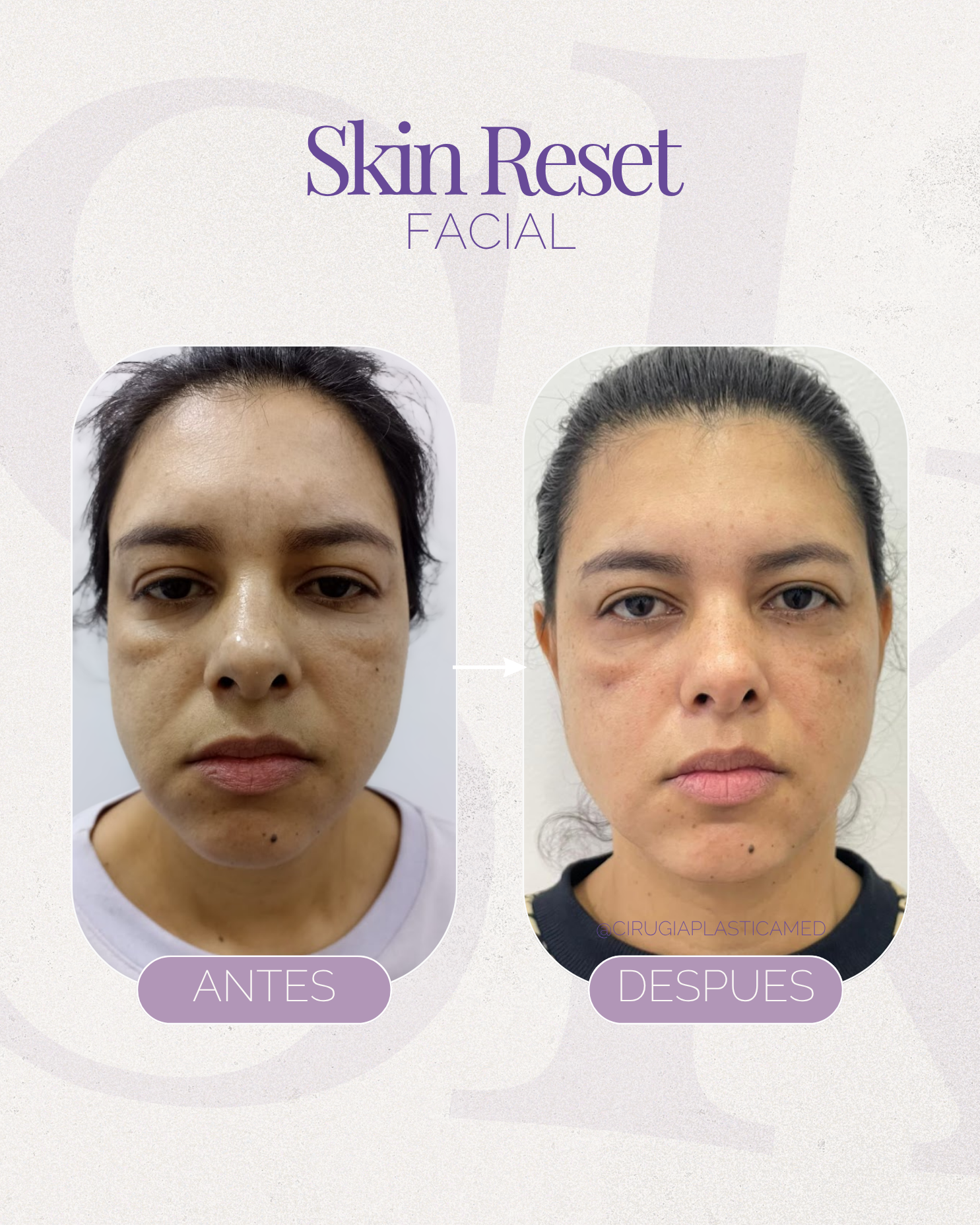 Skin Reset Facial 1