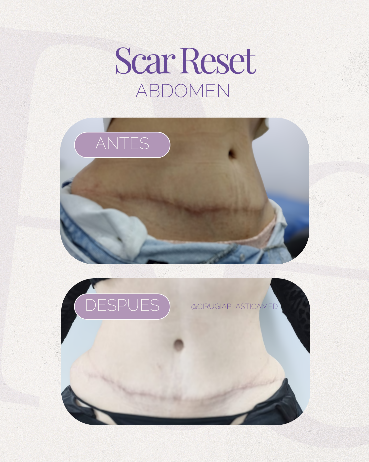 Scar Reset Abdomen