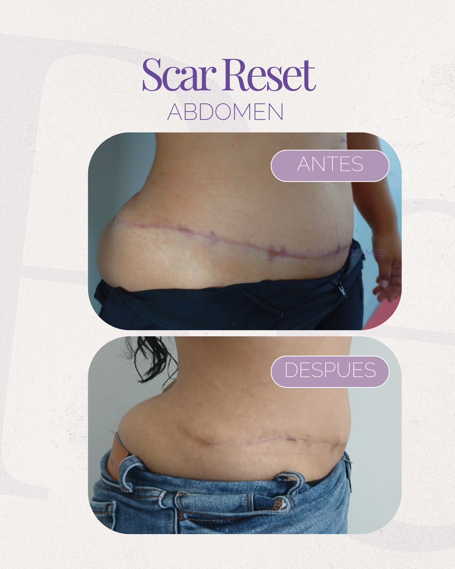Scar Reset Abdomen