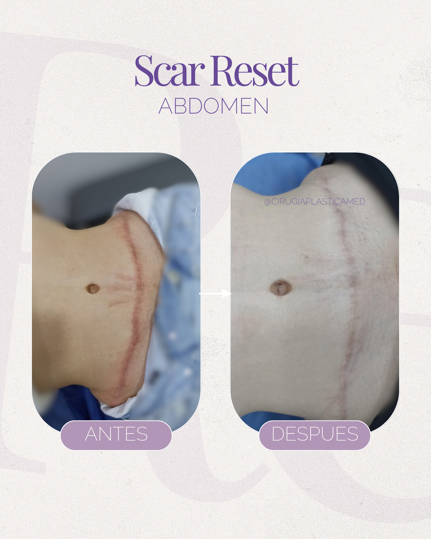 Scar Reset Abdomen