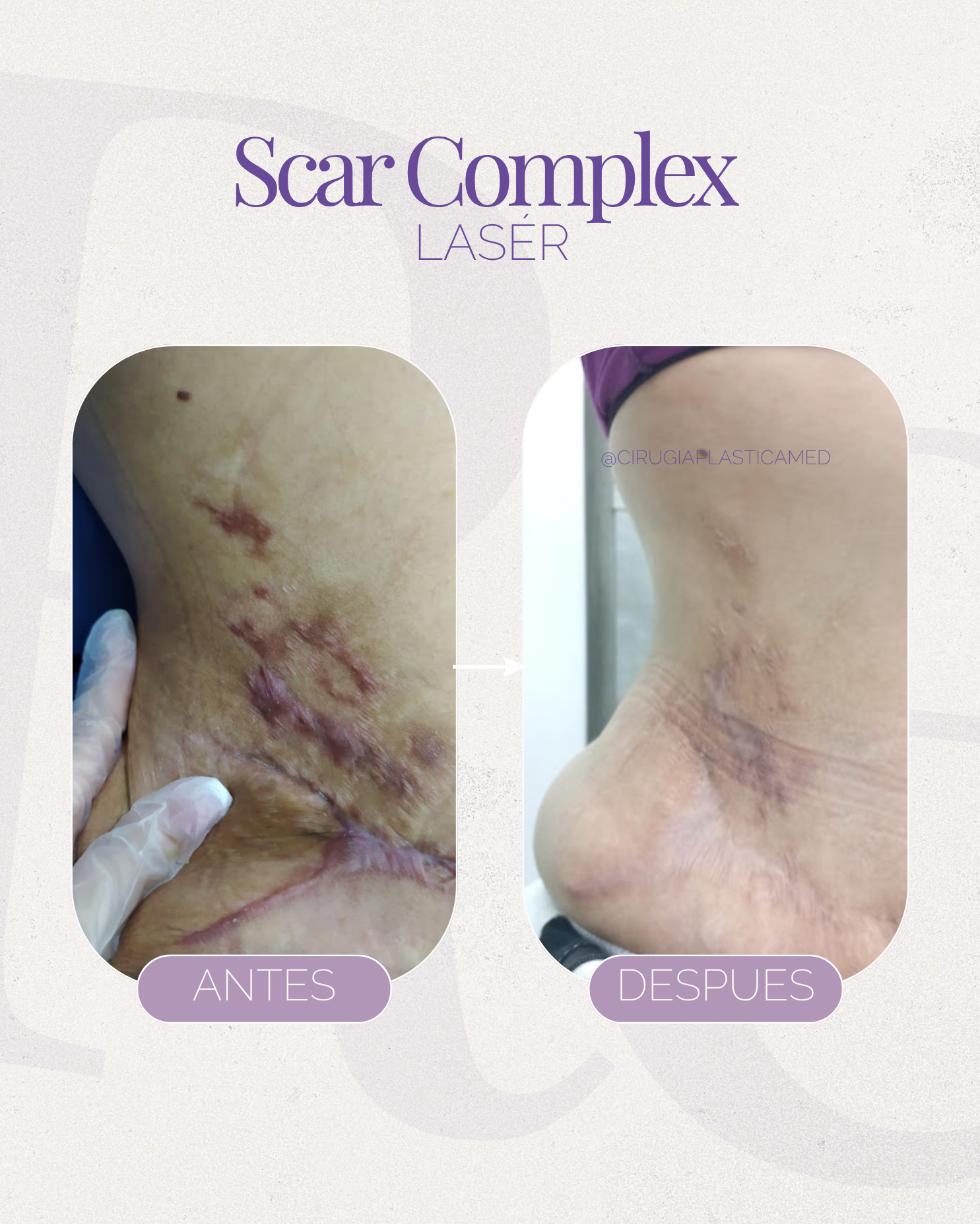 Scar complex laser