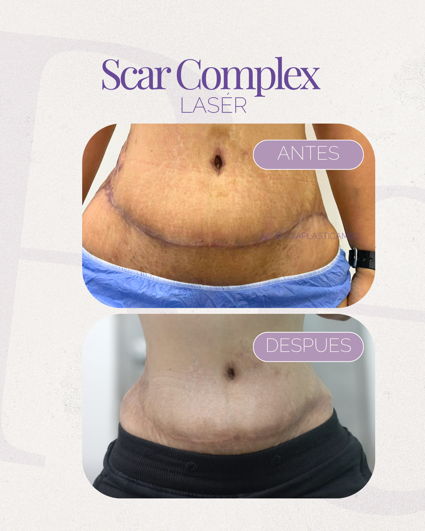 Scar complex laser
