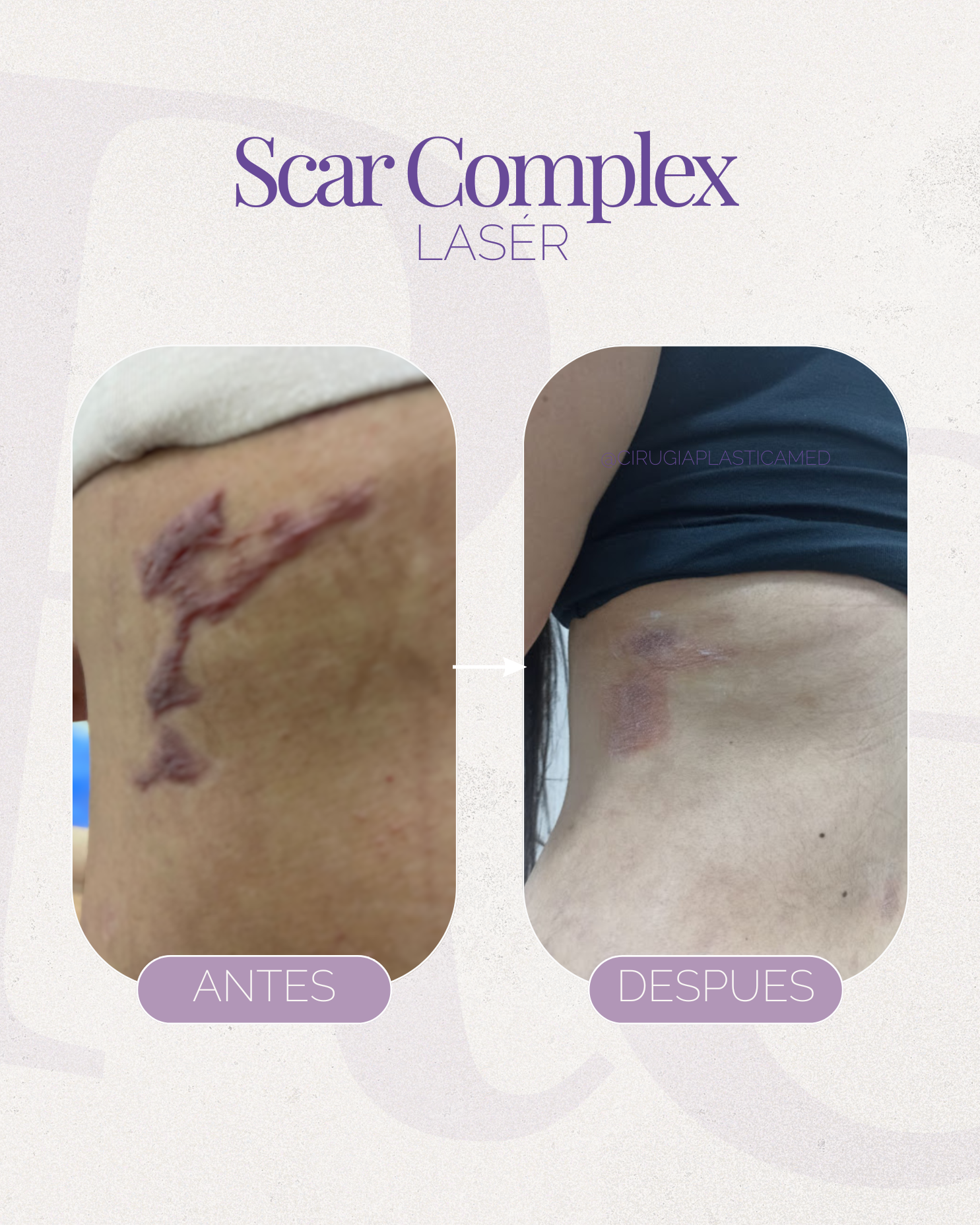 Scar complex laser