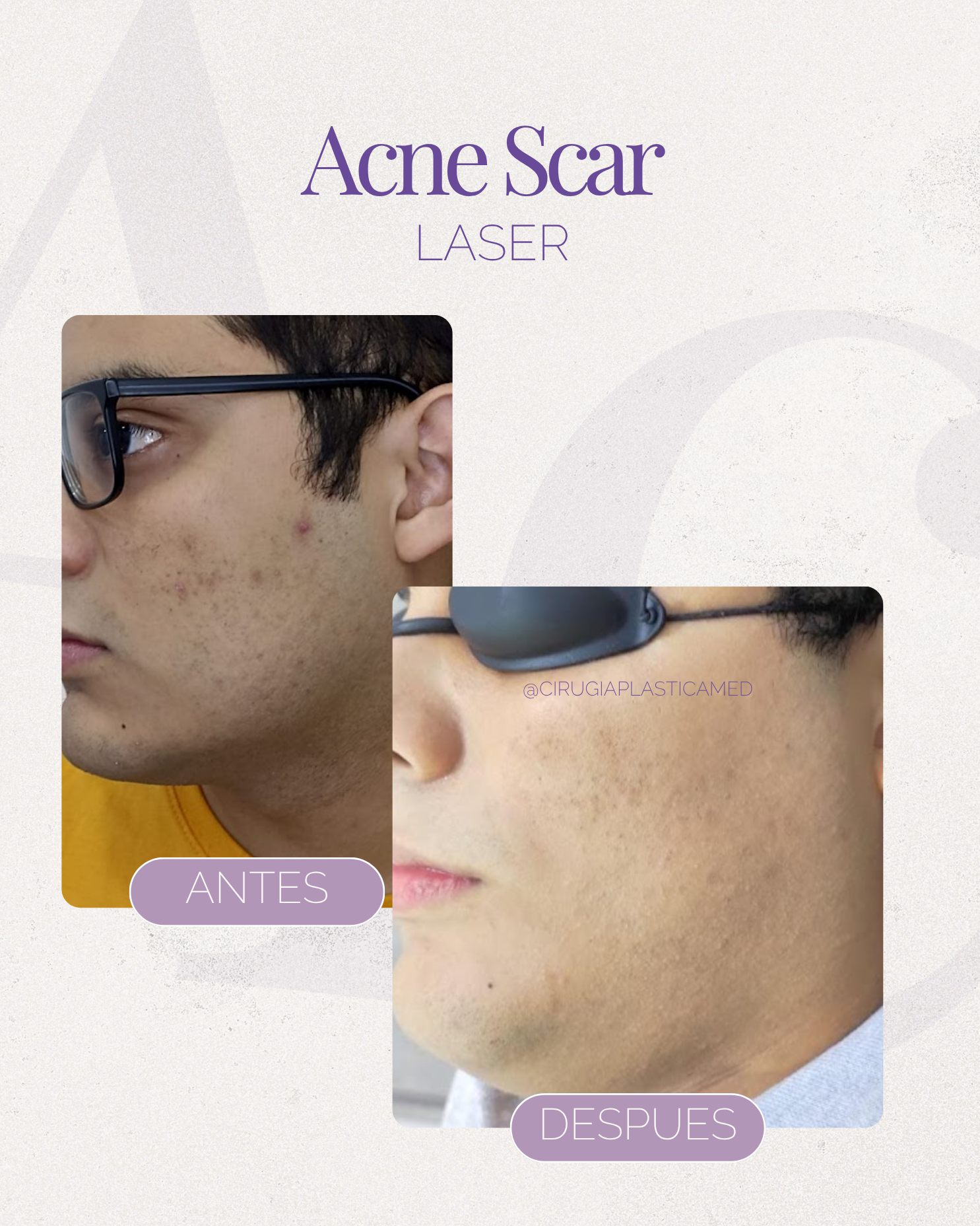 Acne scar reset