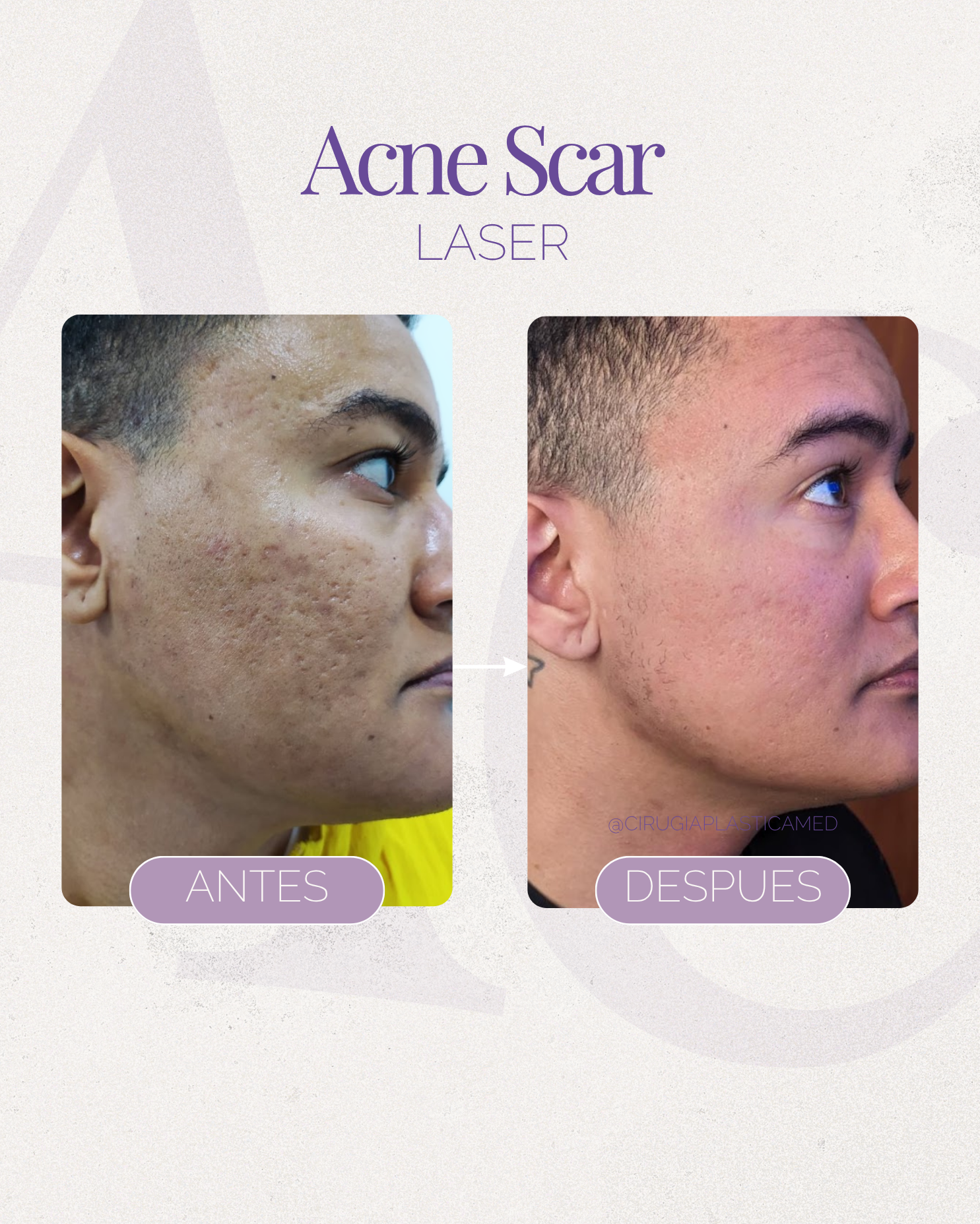 Acne scar reset