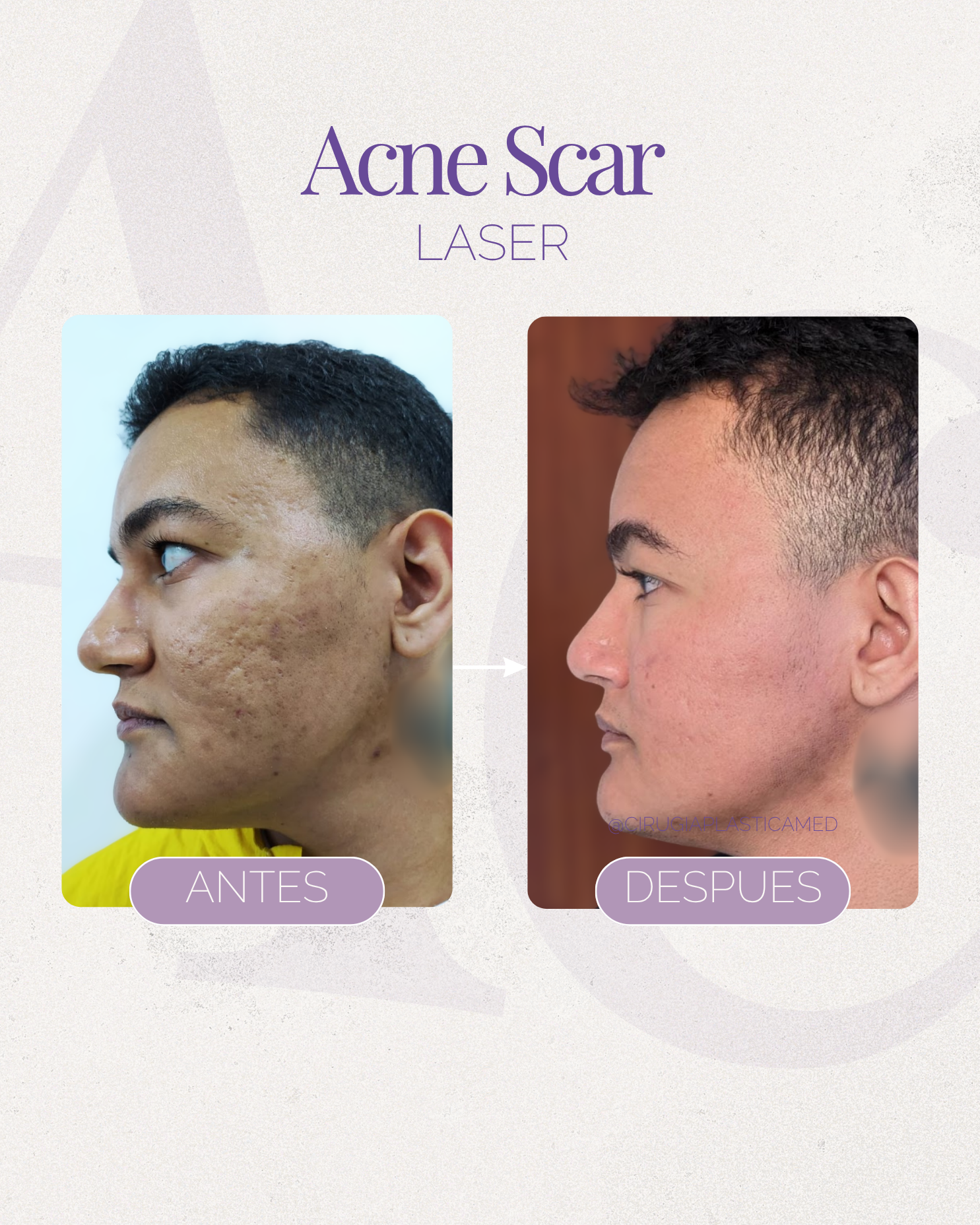 Acne scar reset