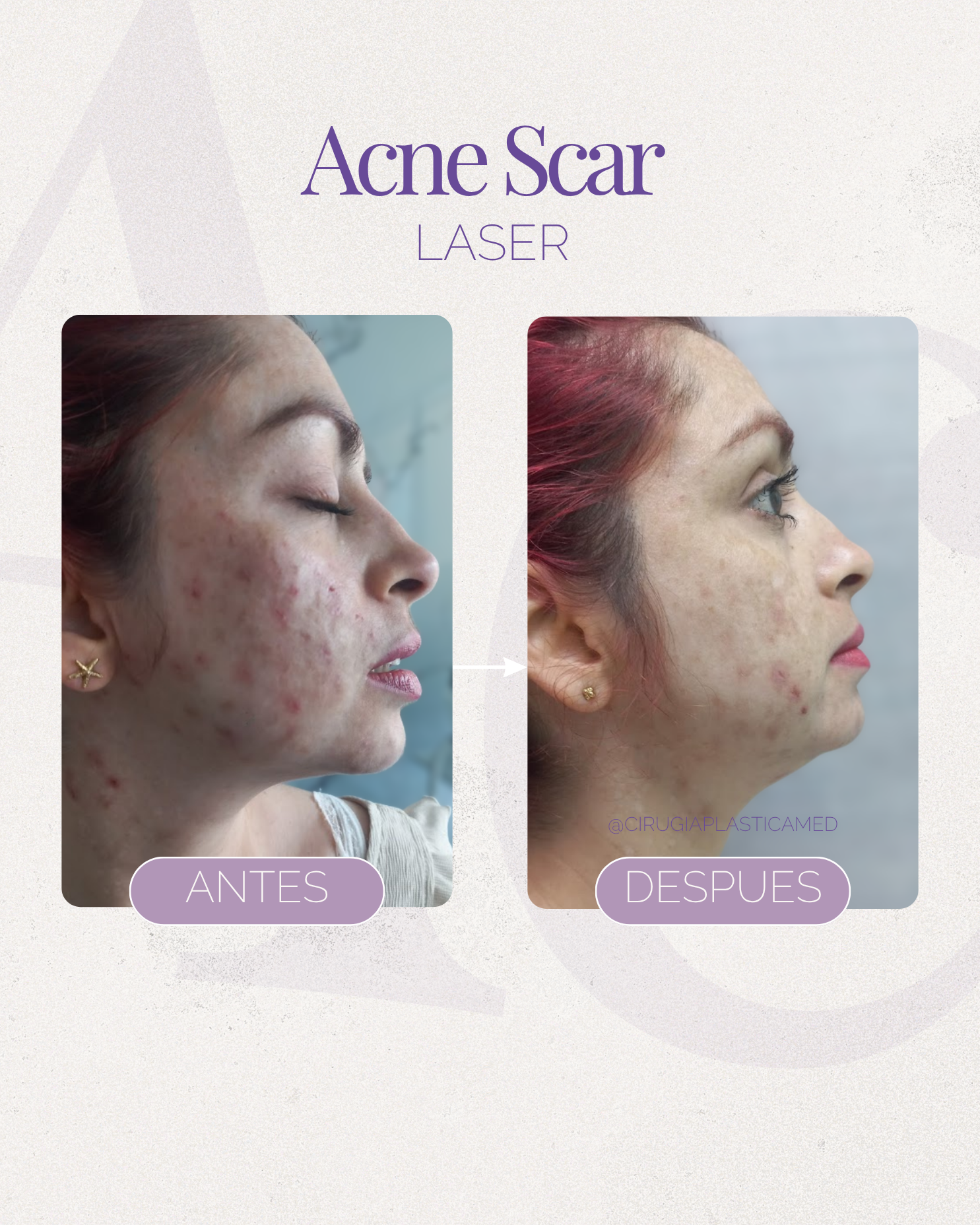 Acne scar reset