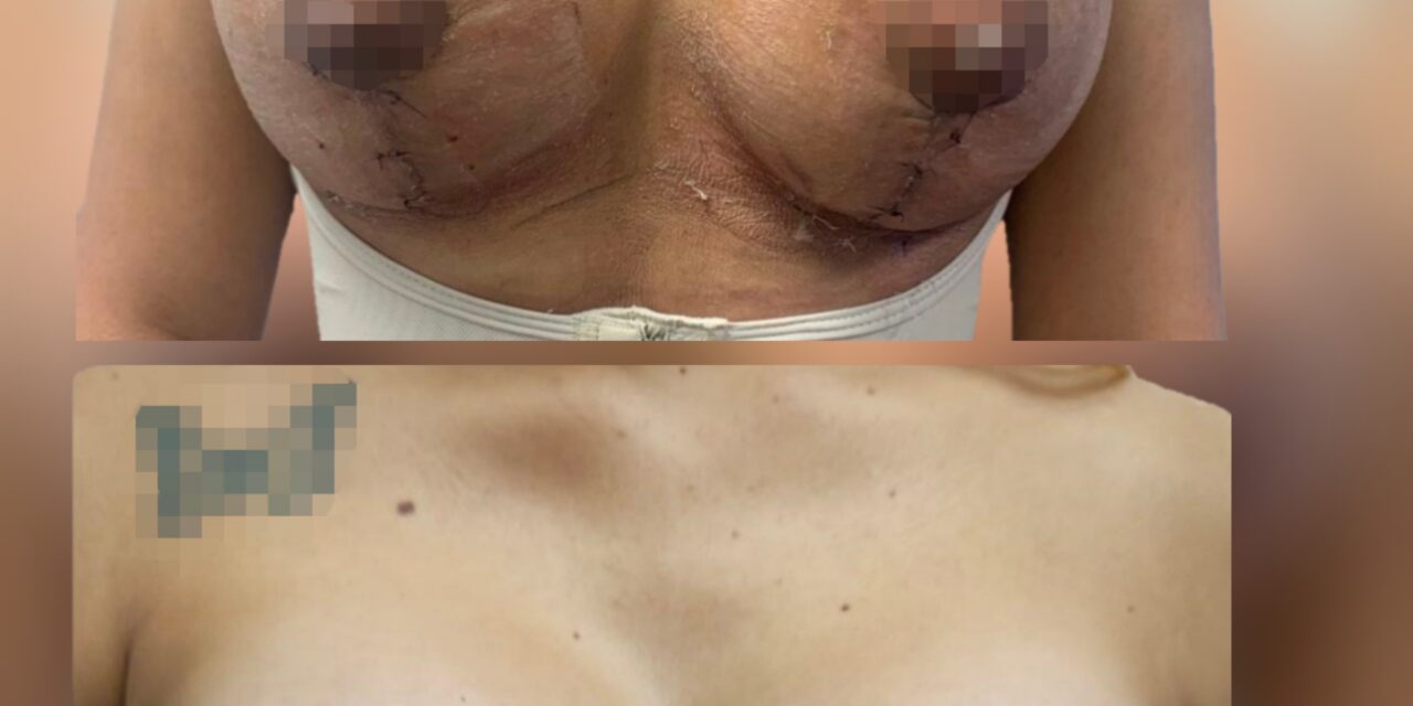 Mamoplastia en Medellín para pacientes internacionales